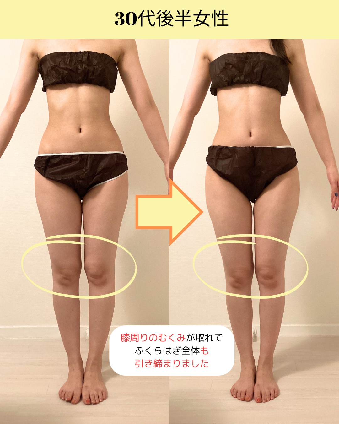 ハイパーナイフ60分で膝回りスッキリ！ビフォーアフター | 脚やせ専門